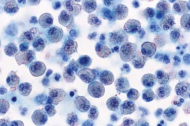 Fig. 4.4, Eosinophilic Pleural Effusion.