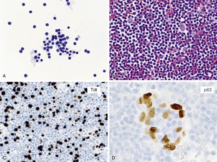 Fig. 4.6, Metastatic Thymoma, Type B2 (Pleural Effusion).