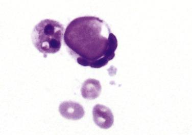 Fig. 4.8, Hematoxylin Body (Lupus Pleuritis).