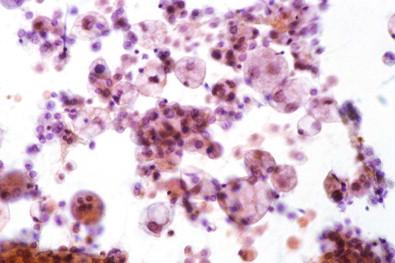 Figure 19-1, Smear of well-preserved adenocarcinoma cells prepared from a pleural effusion that had been stored in the refrigerator at 4°C for 14 days after collection (Papanicolaou, ×MP).