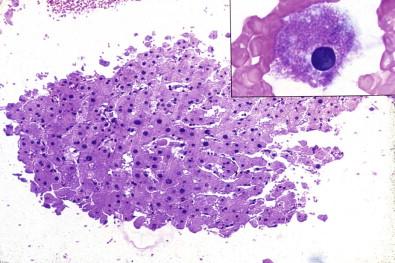 Figure 19-11, Cell block of peritoneal effusion containing a fragment of liver obtained when the paracentesis needle traversed the liver en route to the peritoneal cavity (H&E, ×LP). The inset shows a hepatocyte in a smear of the fluid (Papanicolaou, ×HP).