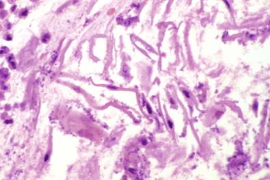 Figure 19-13, Cell block of pleural effusion containing cells of stratified squamous epithelium , which entered the pleural cavity through an esophagopleural fistula (H&E, ×MP).