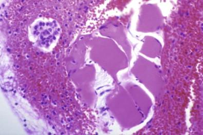 Figure 19-14, Cell block of pleural effusion containing intercostal skeletal muscle detached by the thoracentesis needle (H&E, ×MP).