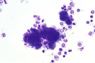 Figure 19-15, Cell block of pleural effusion containing colonies of cocci in a background of inflammatory cells, evidence of bacterial pleuritis (H&E, ×HP).