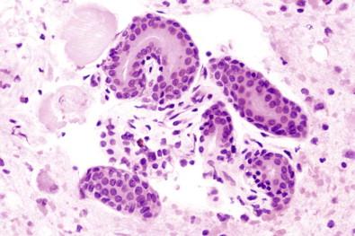 Figure 19-16, Cell block of pleural effusion containing a fragment of subcutaneum detached by the thoracentesis needle; it contains a sweat gland (H&E, ×MP).