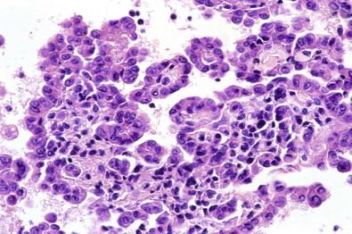 Figure 19-17, Cell block of pleural effusion containing a large fragment of hyperplastic mesothelium with a collagenous stroma. The patient had foreign body granulomatous pleuritis (H&E, ×MP).