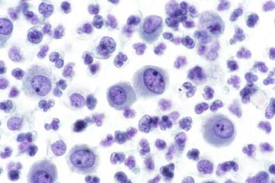 Figure 19-19, Mesothelial cells in a background of inflammatory cells. Note the dense, lightly cyanophilic cytoplasm of the mesothelial cells, which tends to fade at the periphery of the cell, their articulation at flattened apposing cell surfaces, and the smoothly contoured central and eccentric nuclei with prominent nucleoli. Smear of pleural effusion (Papanicolaou, ×MP).