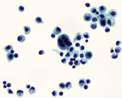 Figure 19-20, A giant multinucleated mesothelial cell. ThinPrep of pleural effusion (Papanicolaou, ×MP).