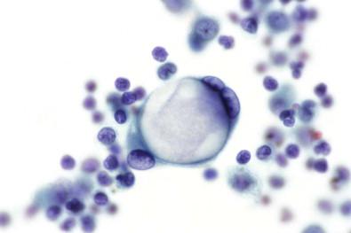 Figure 19-21, A large vacuolated binucleate mesothelial cell attached to a small, non-vacuolated mesothelial cell. Smear of pleural effusion (Papanicolaou, ×HP).