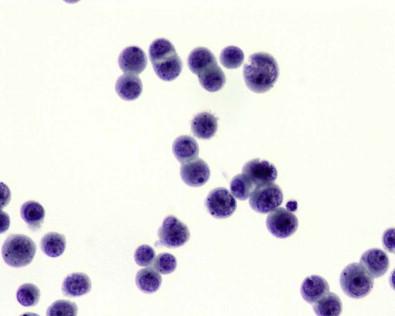 Figure 19-22, A short chain of mesothelial cells joined at apposed surfaces. Windows are forming between the cells. Cytospin of pleural effusion (Papanicolaou, ×MP).