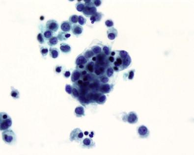 Figure 19-25, Mesothelial cells in a cell ball formation with a 3-dimensional appearance . Cytospin of pleural effusion (Papanicolaou, ×MP).