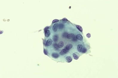 Figure 19-27, A collagen ball in a peritoneal washing. It is 3-dimensional with a collagen core covered by mesothelial cells, which are perceived to be on different levels by focusing up and down. Smear of peritoneal washing (Papanicolaou, ×MP).