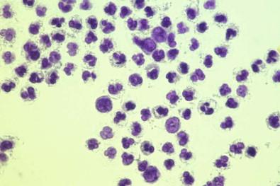 Figure 19-28, Neutrophilic leukocytes in pleural effusion. Their cytoplasmic granularity is barely visible (toluidine blue-stained wet film, ×HP).