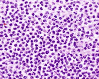 Figure 19-29, ThinPrep of empyema fluid containing numerous neutrophilic leukocytes. Note necrotic background. (Diff-Quick, ×MP).