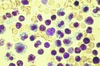 Figure 19-30, Stained wet film of pleural effusion containing a high proportion of eosinophils. Their bilobed nuclei and cytoplasmic granularity are easily perceived (toluidine blue, ×OI).