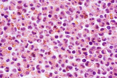 Figure 19-31, Cell block of an eosinophilic pleural effusion. Virtually all of the cells in this field are eosinophils (H&E, ×MP).