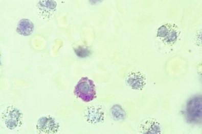 Figure 19-32, A mast cell in a stained wet film of pleural effusion. The cytoplasmic granules of the mast cell are metachromatic and show a delicate purple-pink staining reaction (toluidine blue, ×OI).