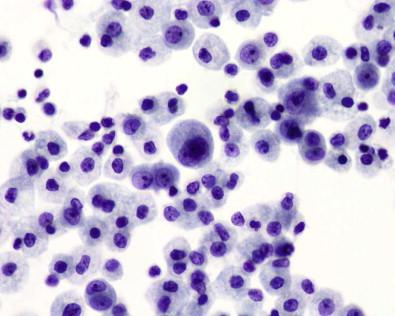 Figure 19-33, Cytospin of peritoneal effusion featuring several histiocytes with round to bean-shaped nuclei and lightly stained lacy cytoplasm and few mesothelial cells (Papanicolaou, ×MP).