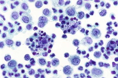 Figure 19-34, A smear of pleural fluid containing mesothelial cells, neutrophils, and two phagocytic histiocytes. They are enlarged and their cytoplasm has ingested cellular material (Papanicolaou, ×HP).