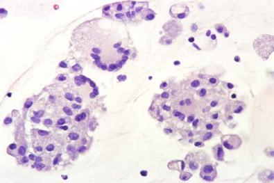 Figure 19-35, Smear of pericardial effusion containing groups of cohesive histiocytes and giant multinucleated histiocytes. The patient had fibrinous pericarditis (Papanicolaou, ×LP).