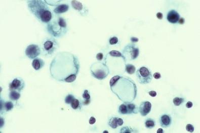 Figure 19-36, Smear of peritoneal effusion containing lymphoid cells and highly vacuolated histiocytes with a signet ring appearance (Papanicolaou, ×HP).