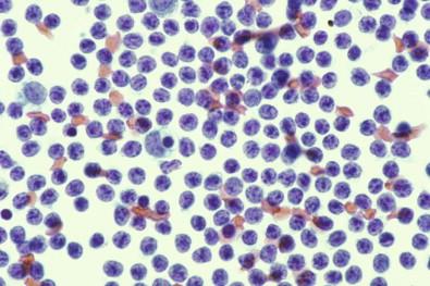 Figure 19-37, Smear of pleural effusion containing numerous small mature lymphocytes (Papanicolaou, ×HP).