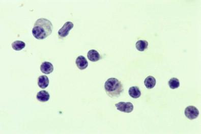 Figure 19-38, Smear of pleural effusion containing lymphocytes and two plasma cells (Papanicolaou, ×HP).