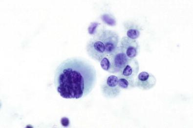 Figure 19-39, Smear of pleural effusion containing a normal megakaryocyte derived from blood that had oozed from the pulmonary parenchyma into the pleural cavities (Papanicolaou, ×HP).