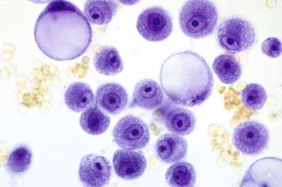 Figure 19-5, Pleural effusion containing cells of metastatic mammary adenocarcinoma and unstained erythrocytes in a toluidine blue-stained wet film (×MP).