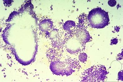 Figure 19-6, Pleural effusion containing fragments of metastatic ductal carcinoma of the breast that the stain had not completely penetrated (toluidine blue-stained wet film, ×LP).