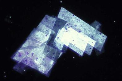 Figure 19-7, Pleural effusion containing flat, angulated cholesterol crystals , a manifestation of long-standing effusion, in this case caused by rheumatoid pleuritis (toluidine blue-stained wet film, polarized light, ×MP).