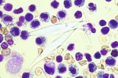 Figure 19-8, Pleural effusion containing Charcot–Leyden crystals in a background of eosinophils, lymphocytes, and erythrocytes (toluidine blue-stained wet film, ×MP).