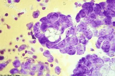 Figure 19-9, Peritoneal effusion containing a papillary fragment of ovarian adenocarcinoma containing a psammoma body (toluidine blue-stained wet film, ×MP).