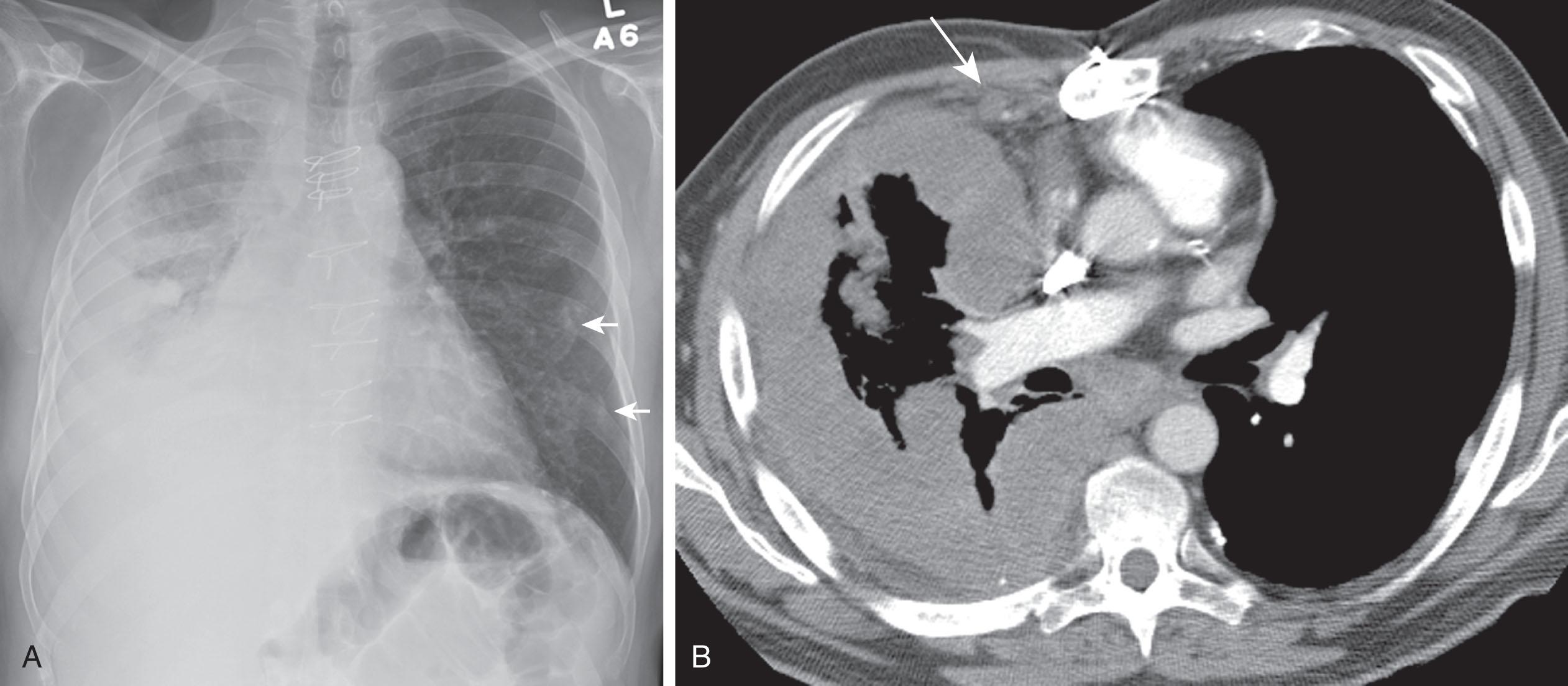 Figure 9.1, A 64-year-old man with epithelioid malignant pleural mesothelioma. A , Posteroanterior chest radiograph shows nodular pleural thickening forming a rind of tumor encasing the right lung. Note left calcified pleural plaques ( arrows ) from prior exposure to asbestos. B , Contrast-enhanced chest computed tomography shows that circumferential nodular right pleural thickening along mediastinal surface is indistinguishable from subcarinal adenopathy. Note adenopathy of the right internal mammary lymph node ( arrow ), a lymphatic drainage pathway for diseases involving the anterior parietal pleura.