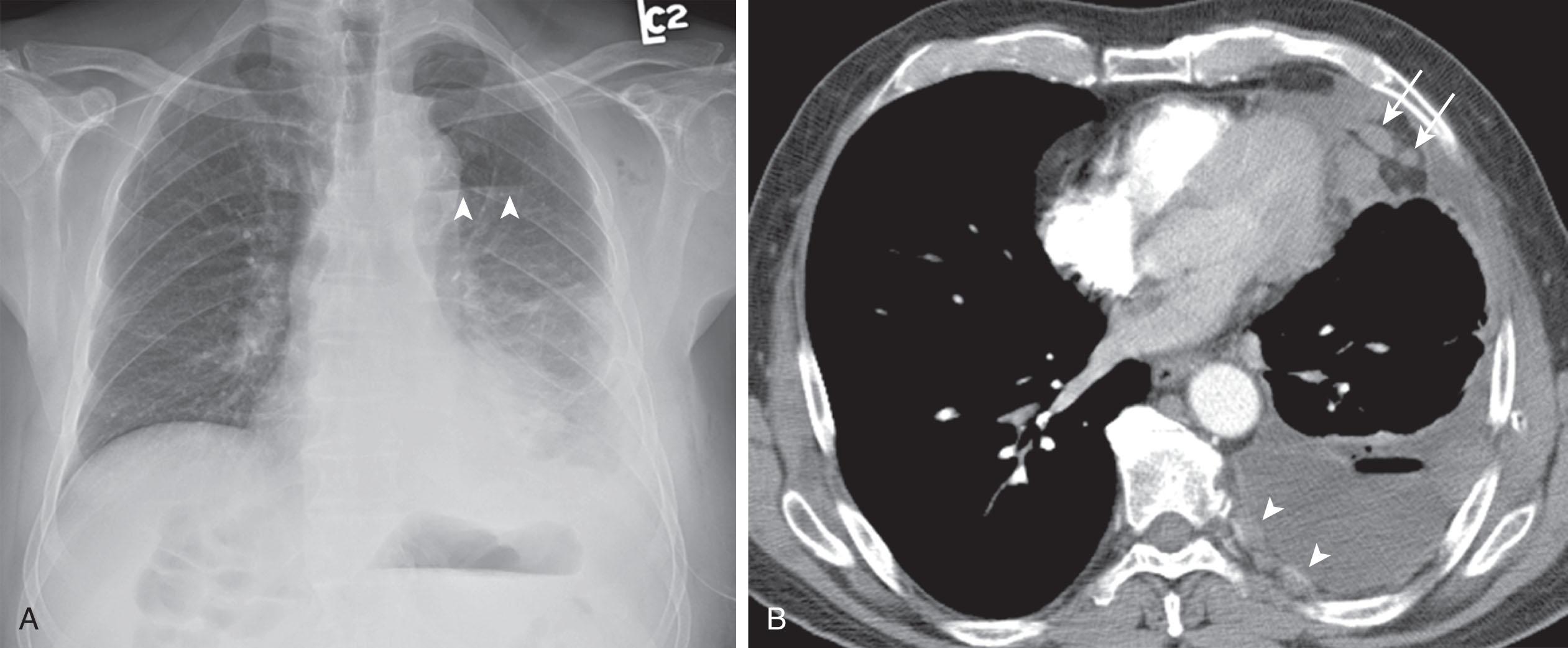 Figure 9.2, A 70-year-old man presented with shortness of breath and underwent left thoracentesis. A , Posteroanterior chest radiograph shows a left pleural catheter with an air–fluid level ( arrowheads ) in the left pleural space. B , Contrast-enhanced computed tomography scan of the chest shows air and fluid in the left pleural space. Nodular left pleural thickening is consistent with malignant pleural mesothelioma. Note that the lymphatic drainage system for the parietal pleura can be via the left anterior diaphragmatic ( arrows ) and left intercostal ( arrowheads ) lymph nodes.