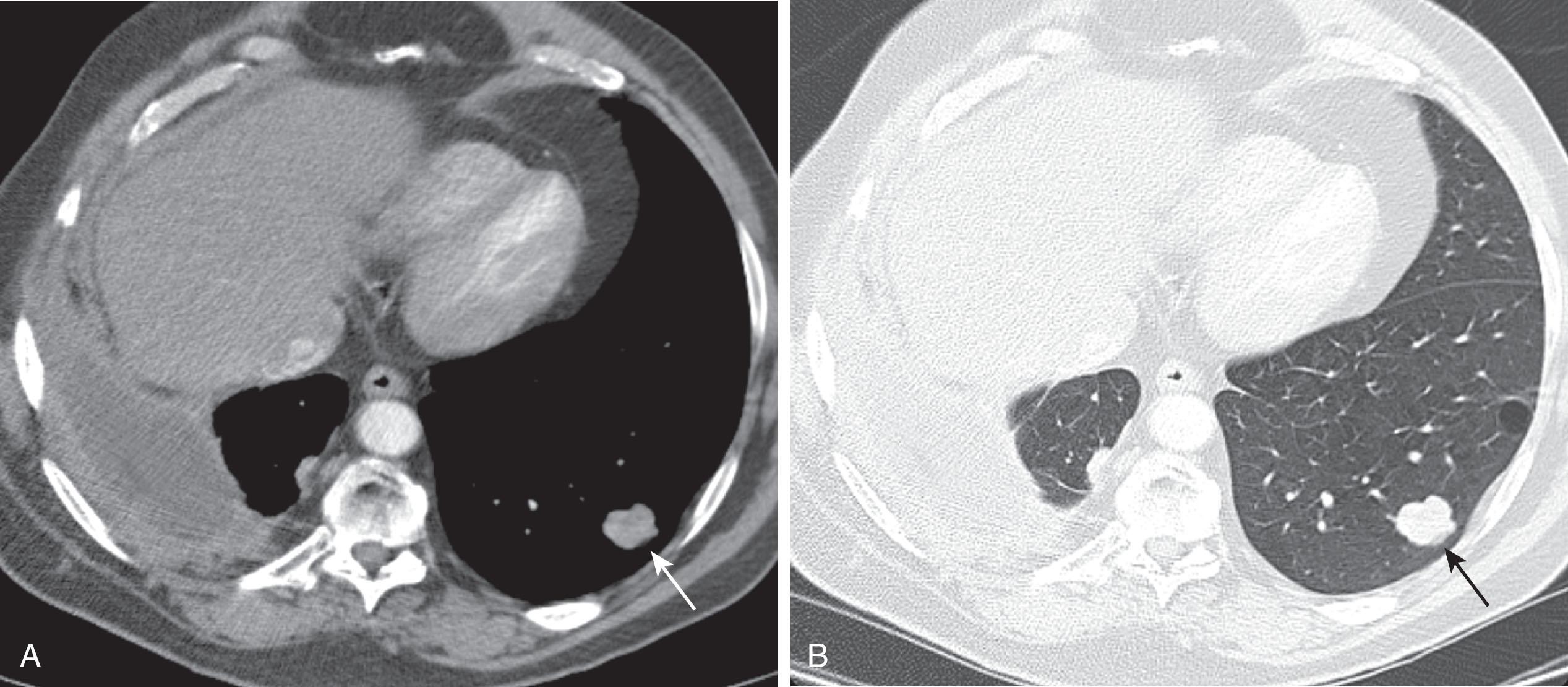 Figure 9.3, A 61-year-old man with right epithelioid malignant pleural mesothelioma. Contrast-enhanced computed tomography with mediastinal window ( A ) and lung window ( B ) shows nodular right pleural thickening, small right pleural effusion, and rounded atelectasis in the middle and right lower lobes. Note the well-circumscribed left lower lobe 1.5-cm nodule ( arrows ) consistent with metastasis. The presence of metastatic disease precluded surgery, and the patient was treated with cisplatin and pemetrexed.