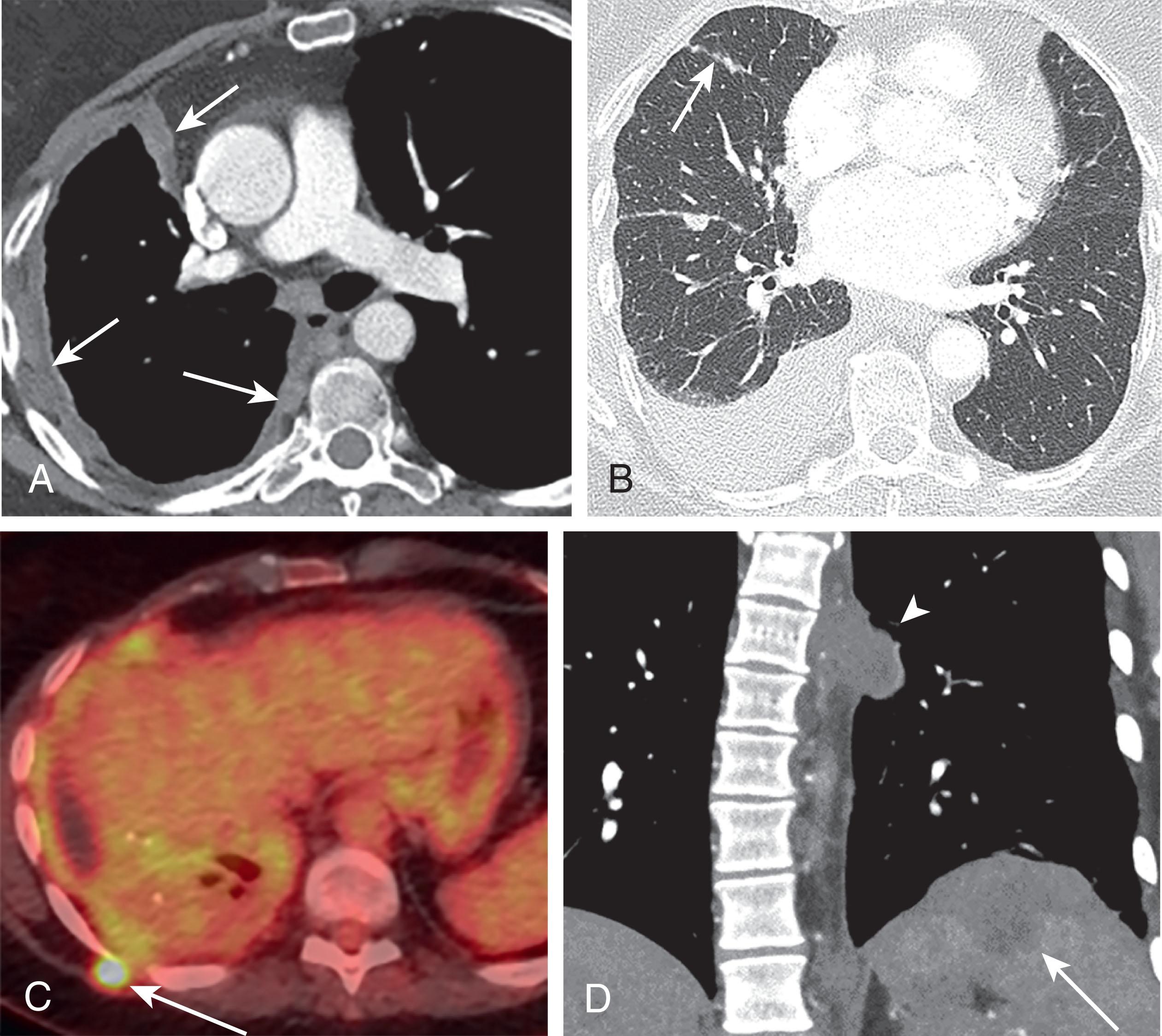 Figure 9.4, Cross-section ( A – D ) and illustration ( E – H ) of the local extent of the primary tumor (T descriptor) in the tumor-node-metastasis classification of malignant pleural mesothelioma. Axial computed tomography (CT) with soft tissue window ( A ) and illustration ( E ) of a T1 tumor involving the ipsilateral parietal pleura (including mediastinal and diaphragmatic pleura) with or without involvement of visceral pleura ( arrows ). Axial CT with lung window ( B ) and illustration ( F ) of a T2 tumor involving each ipsilateral pleural surface with confluent visceral pleural tumor including fissures ( arrows ) or extension of tumor from visceral pleura into underlying pulmonary parenchyma or involvement of diaphragmatic muscle. Axial fused 2-[ 18 F] fluoro-2-deoxy-D-glucose positron emission tomography/CT ( C ) and illustration ( G ) of a T3 locally advanced but potentially resectable tumor. Tumor is involving all ipsilateral pleural surfaces with a solitary, completely resectable focus of tumor extending into soft tissues of chest wall ( arrow ). Coronal reformat CT with soft tissue window ( D ) and illustration ( H ) of a T4 locally advanced technically unresectable tumor. Tumor is involving all ipsilateral pleural surfaces with direct transdiaphragmatic extension of tumor to peritoneum ( arrow ) and thoracic spine ( arrowhead ).