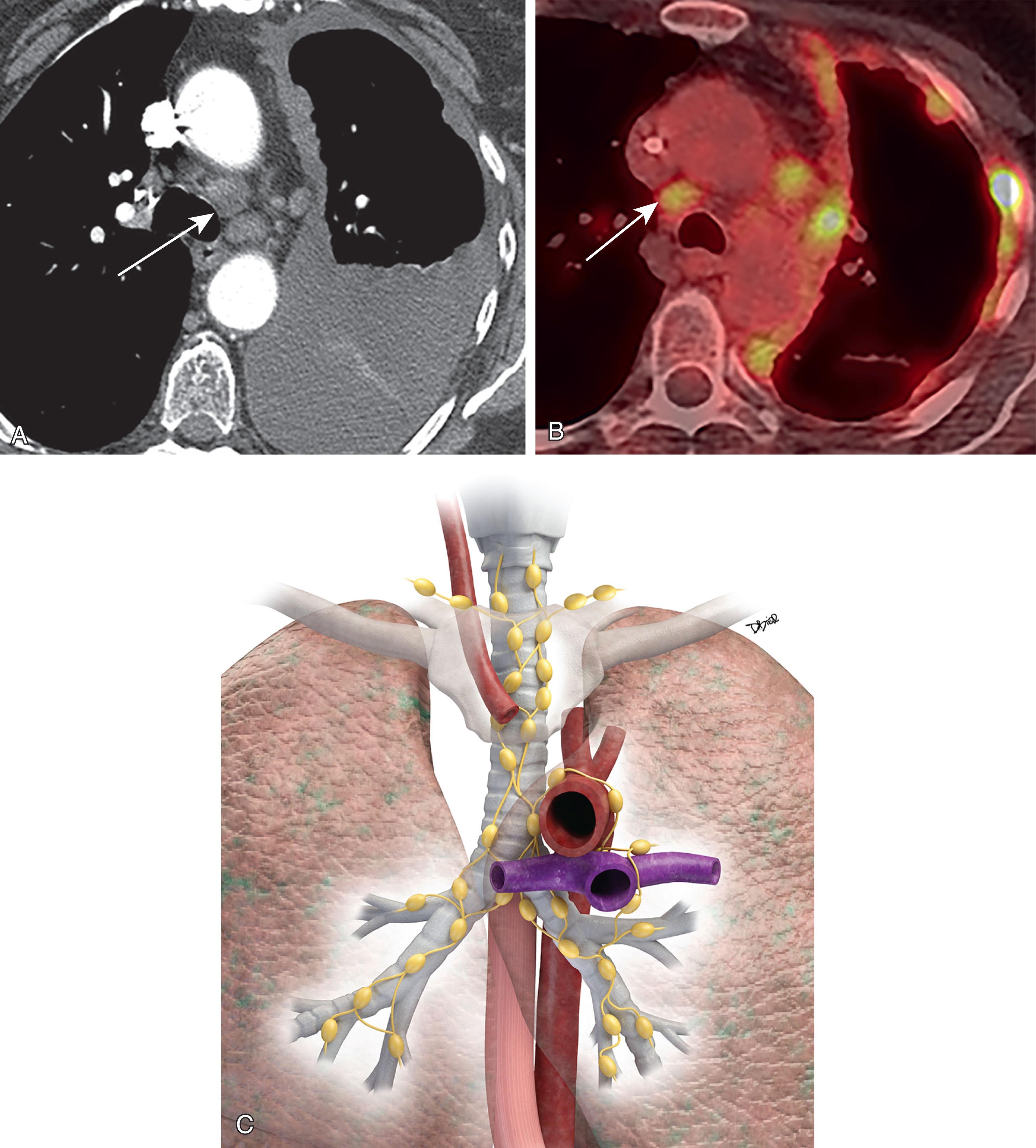 Figure 9.5, Cross-section ( A – B ) and illustration ( C ) of nodal disease spread (N descriptor) in the tumor-node-metastasis classification of malignant pleural mesothelioma. Axial computed tomography (CT) with soft tissue window ( A ); N1 denotes metastases in the ipsilateral bronchopulmonary, hilar, or mediastinal ( arrow ) lymph nodes (including the internal mammary, peridiaphragmatic, pericardial fat pad, or intercostal lymph nodes). Axial fused 2-[ 18 F] fluoro-2-deoxy-D-glucose positron emission tomography/CT ( B ); N2 denotes metastases in the contralateral bronchopulmonary, hilar, or mediastinal ( arrow ) lymph nodes or ipsilateral or contralateral supraclavicular lymph nodes.