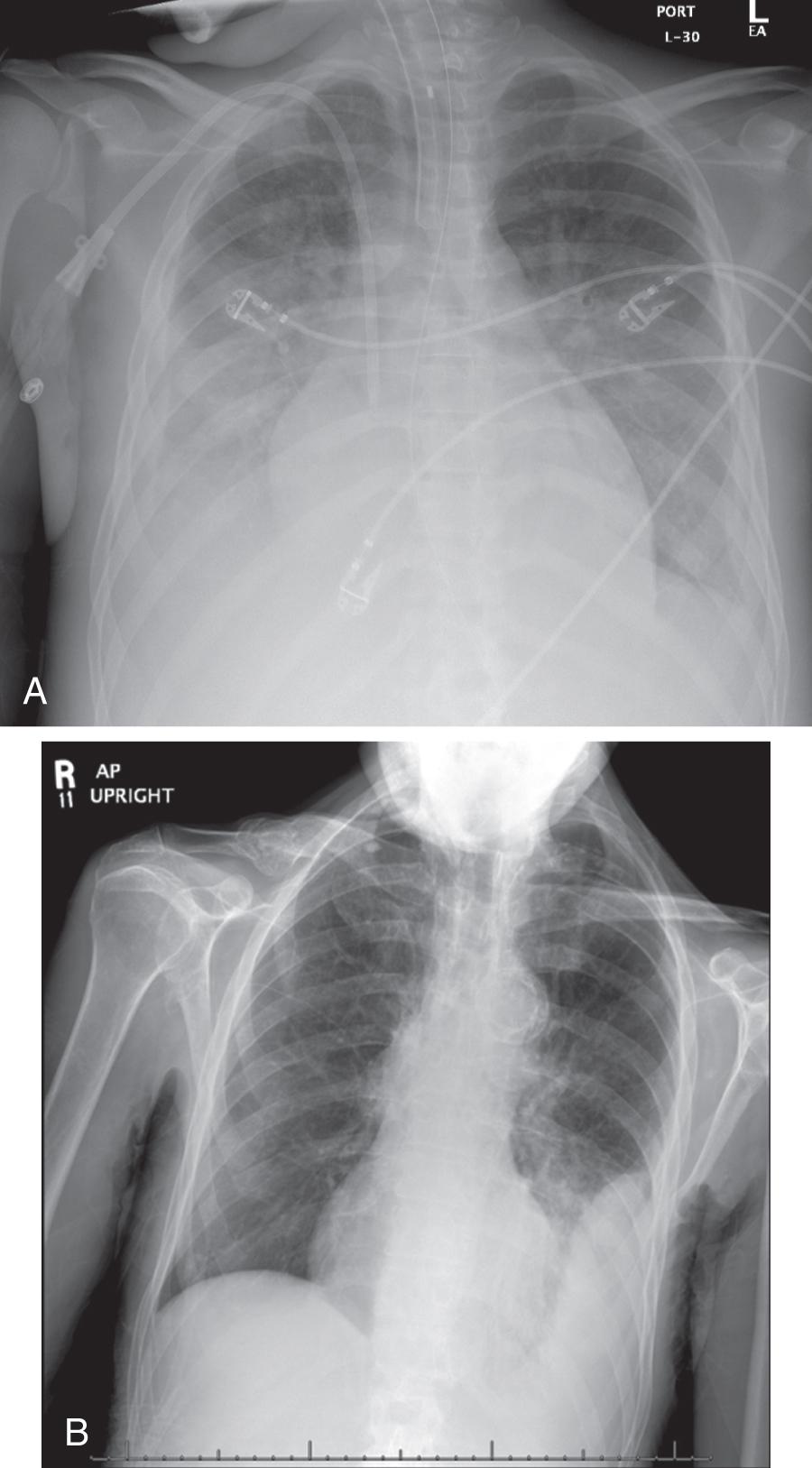 Fig. 12.1, A, Semi-recumbent portable chest x-ray demonstrates bilateral basilar hazy opacities silhouetting the diaphragm. Large bilateral pleural effusions were confirmed on bedside ultrasound. B, Loculated effusion with “D-sign.”