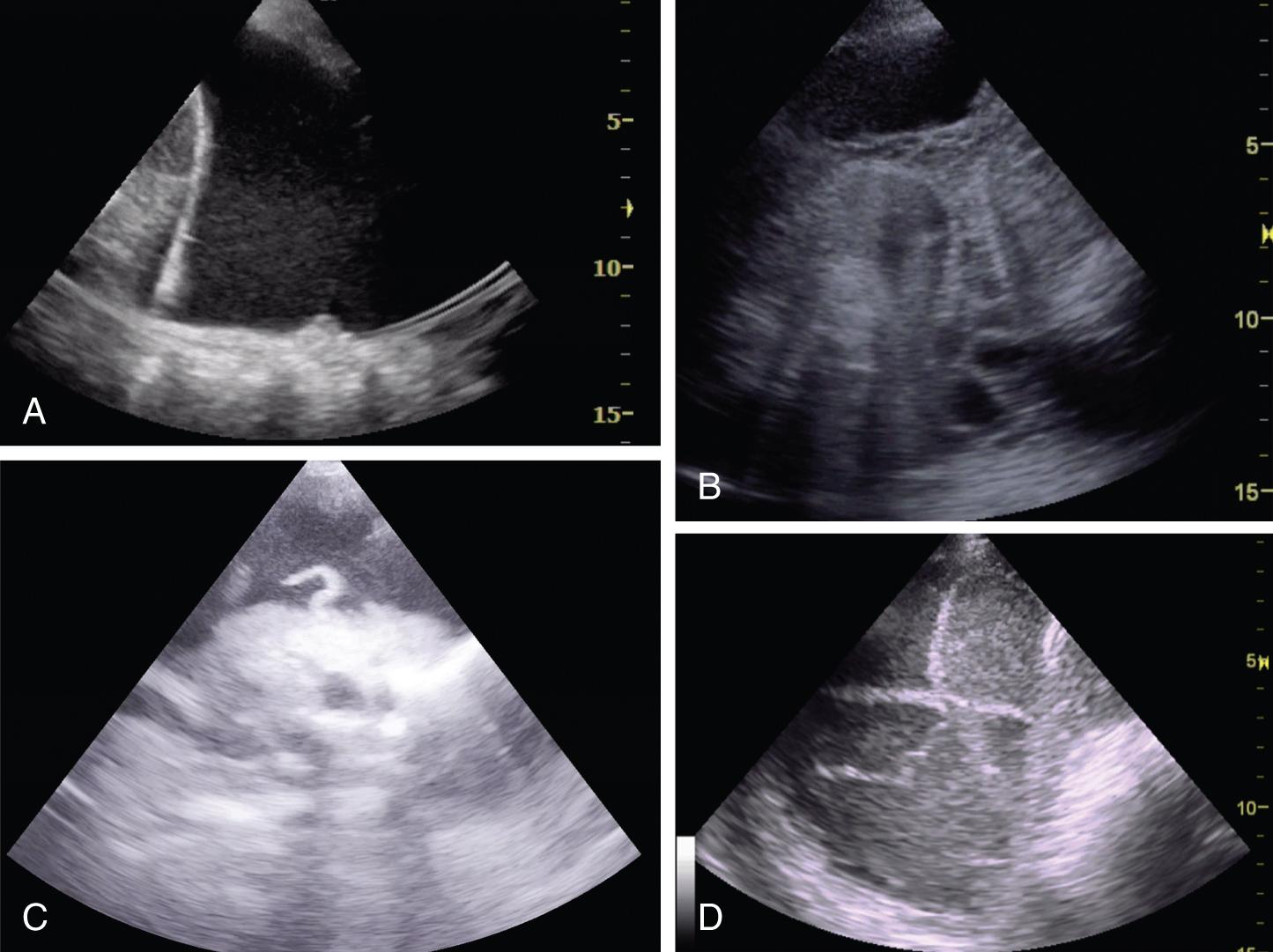 Fig. 12.2, Point-of-care ultrasound of pleural space shows (A) anechoic simple effusion, (B) complex effusion with multiple septations, (C) complex effusion with debris (blood clot in this example), and (D) empyema with septations and increased echogenicity of pleural fluid.