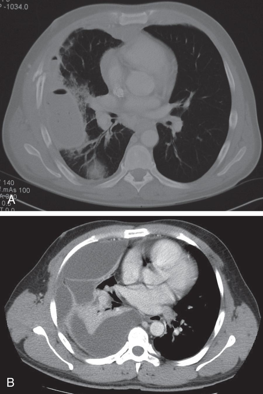 Fig. 12.3, Contrast-enhanced CT scan of the chest shows (A) simple loculated effusion and (B) organized multiloculated effusion. The multiloculated effusion is unlikely to resolve with tube thoracostomy and fibrinolytics; early VATS should be considered in these scenarios.