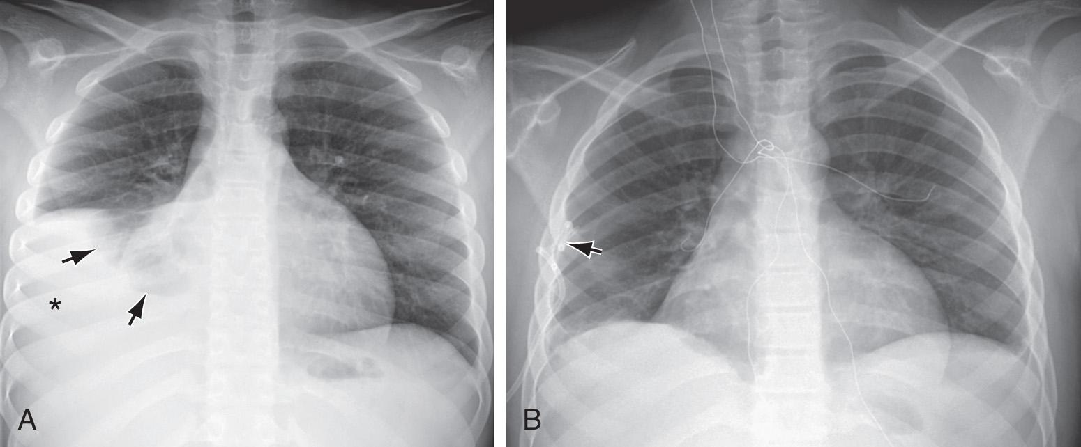 Fig. 429.1, A, Right pleural effusion (asterisk) caused by lupus erythematosus in a 12 yr old child. Note compressed middle and lower lobes of the right lung (arrows) . B, The effusion was evacuated and the right lung was completely reexpanded after insertion of the pigtail chest tube (arrow) .