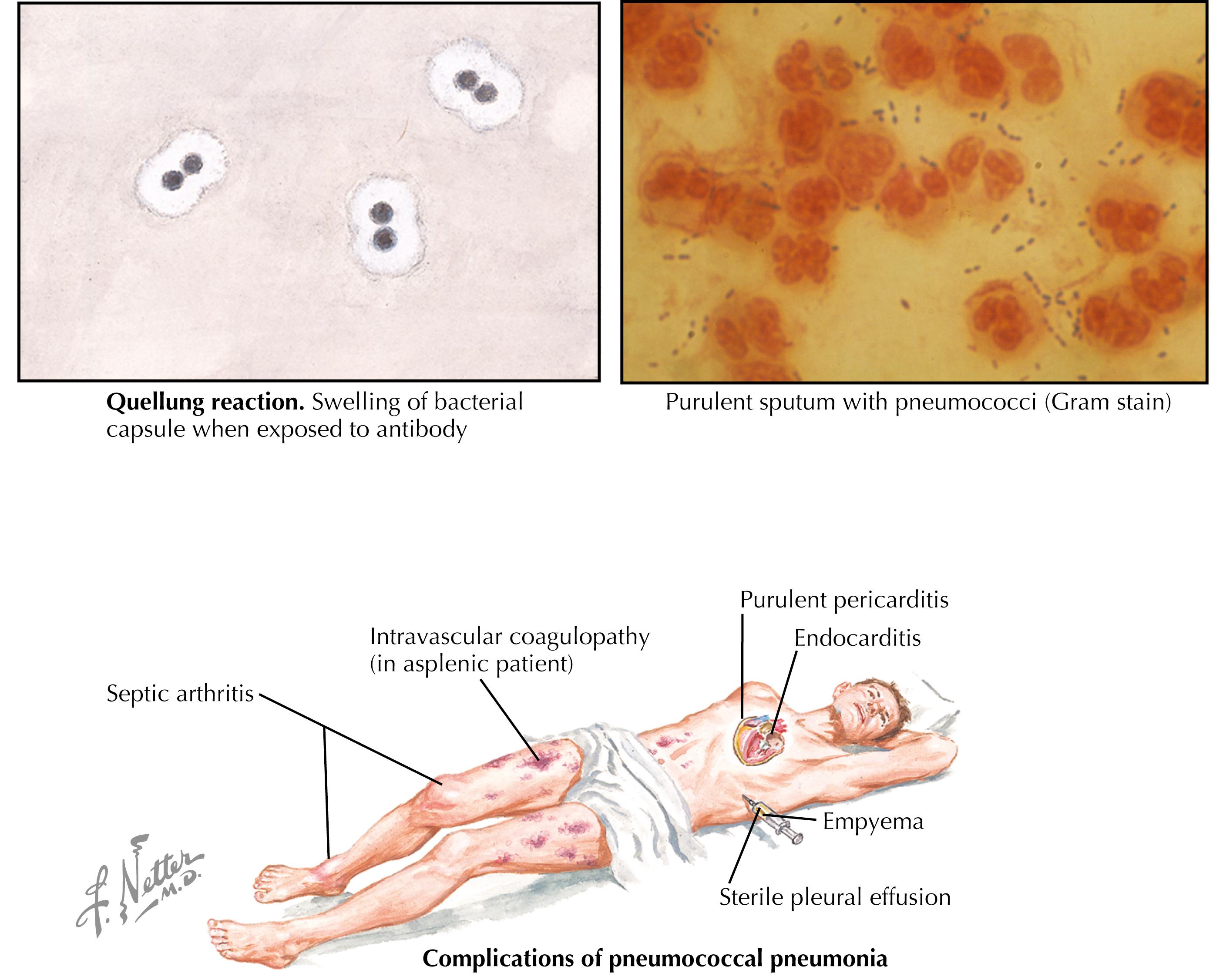 Fig. 5.1, Pneumococcal disease.