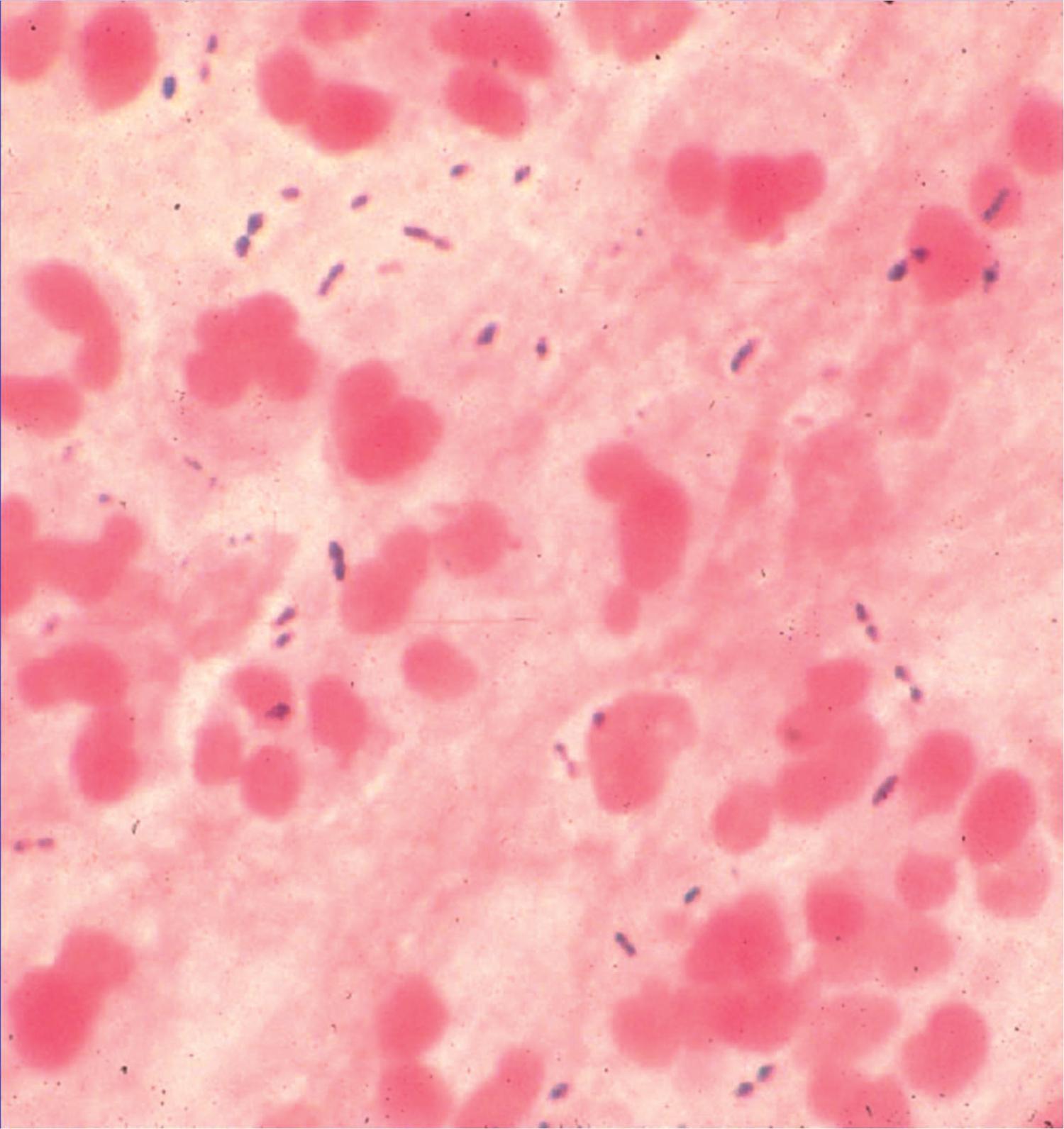 Fig. 48.1, Microscope image (×440) of a Gram-stained specimen of sputum showing proteinaceous background, polymorphonuclear cells, and gram-positive, slightly elongated cocci singly and in pairs. Culture yielded Streptococcus pneumoniae as the predominant organism.