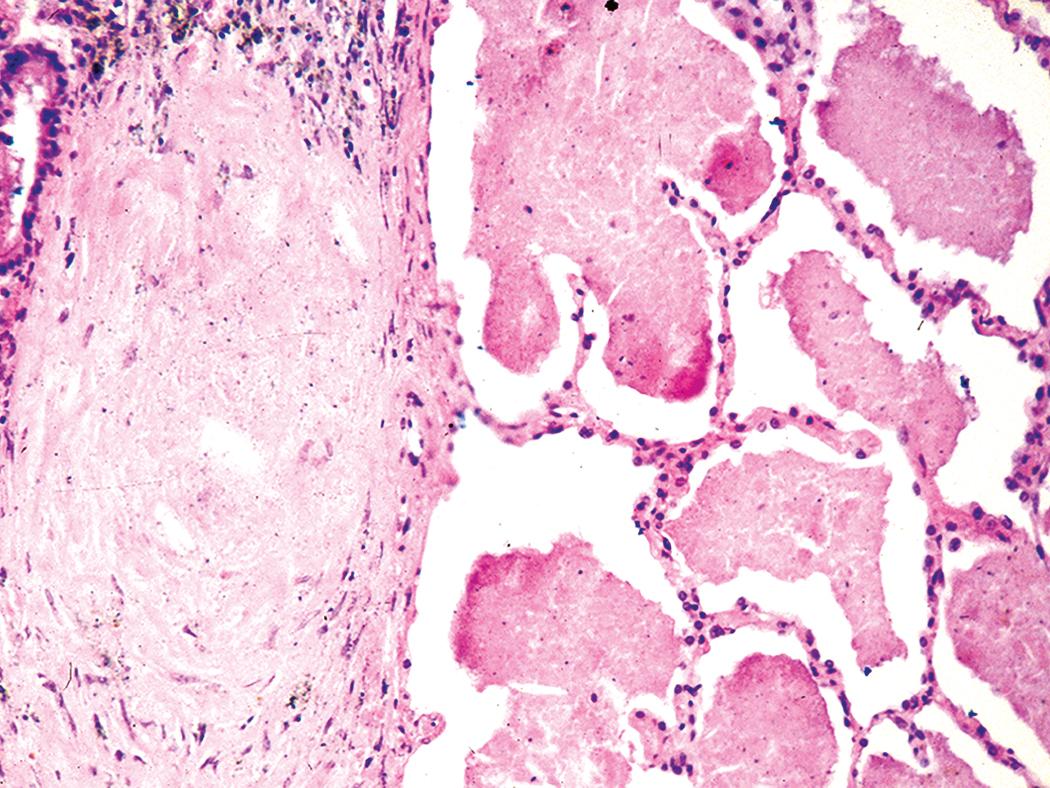 Figure 10.11, Acute silicosis. Granular eosinophilic material fills alveoli, imparting an appearance similar to that seen in pulmonary alveolar proteinosis. A silicotic nodule is also evident on the left side of this photomicrograph.