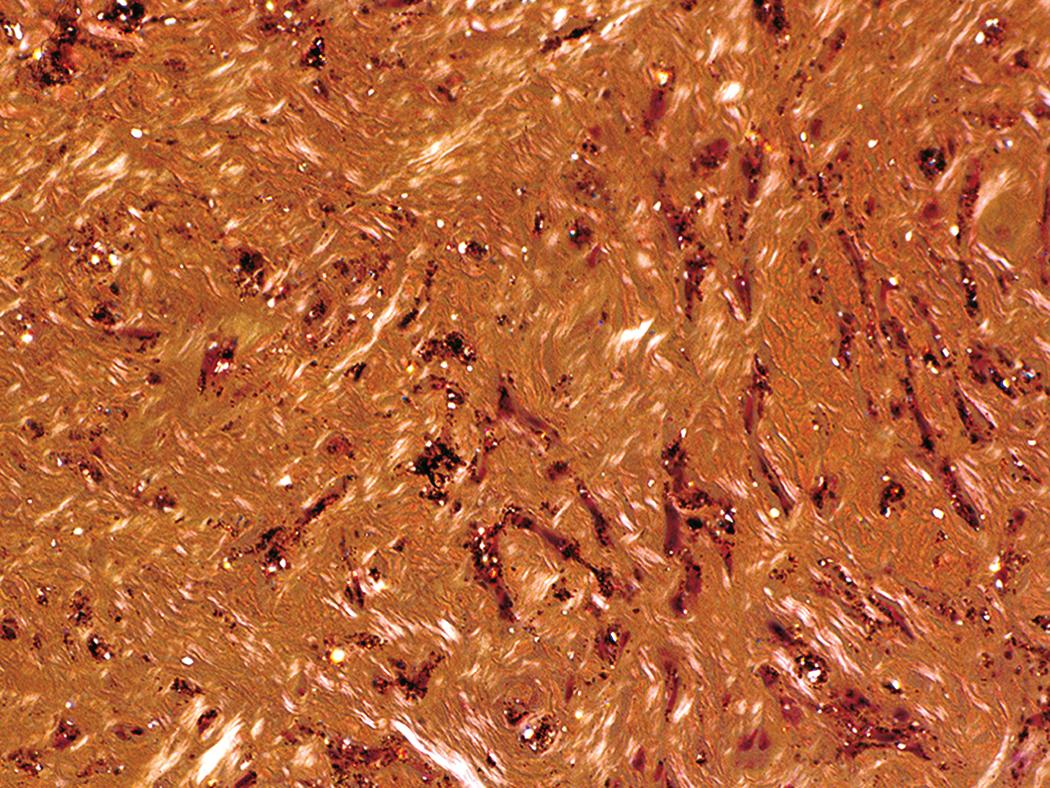 Figure 10.12, Silicosis. Partial polarization of a silicotic nodule demonstrates faintly birefringent silica particles.