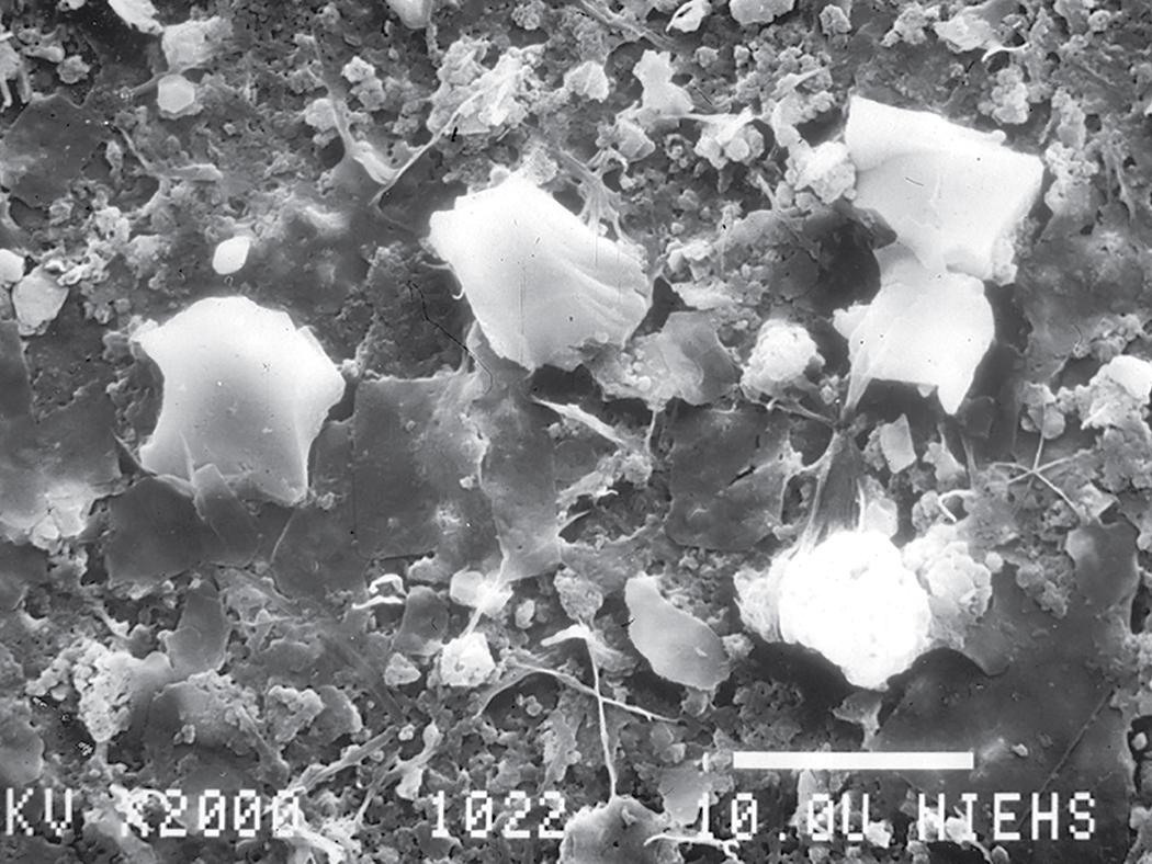 Figure 10.13, Silicosis. Scanning electron microscopy demonstrates angulated silica particles.