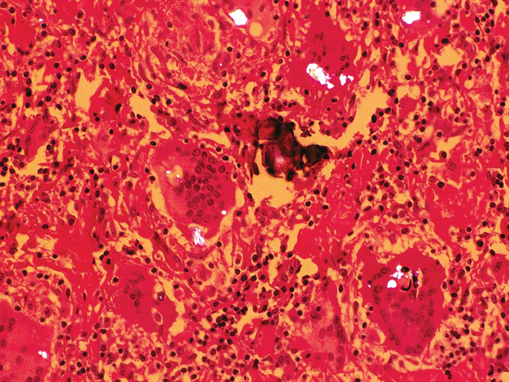 Figure 10.15, Birefringent particles in sarcoidosis. In contrast to silicosis, the granulomas of sarcoidosis sometimes contain large irregularly shaped birefringent particles of endogenous calcium oxalate.