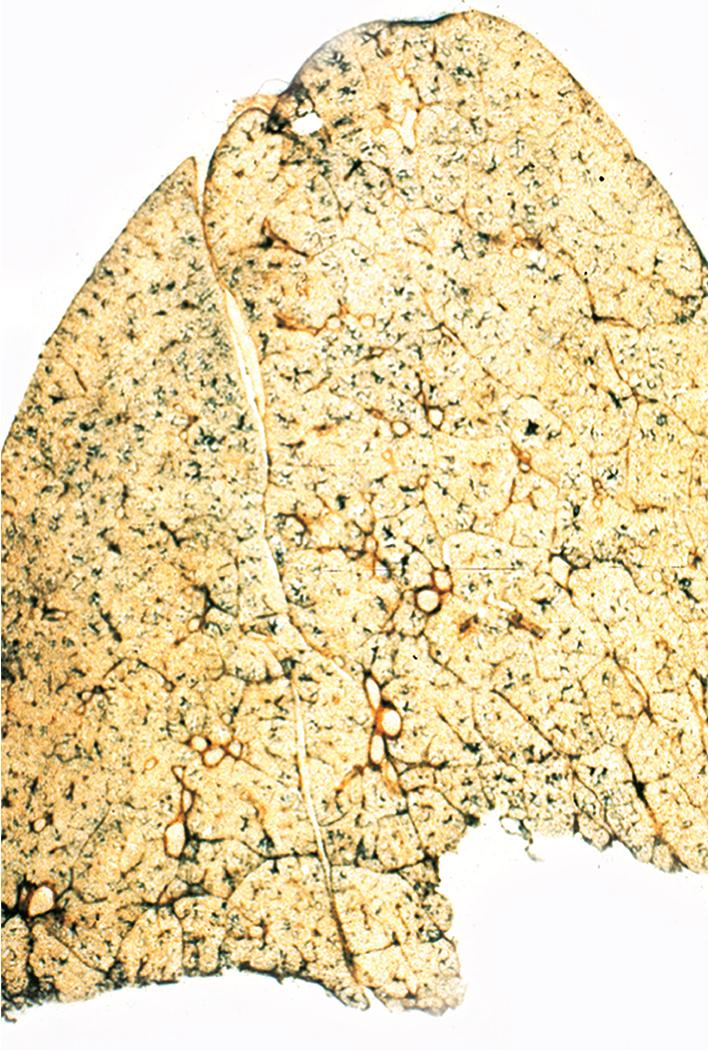 Figure 10.16, Normal lung. A Gough-Wentworth thin section of normal lung shows scattered minimal accumulations of black pigment and intact parenchyma.