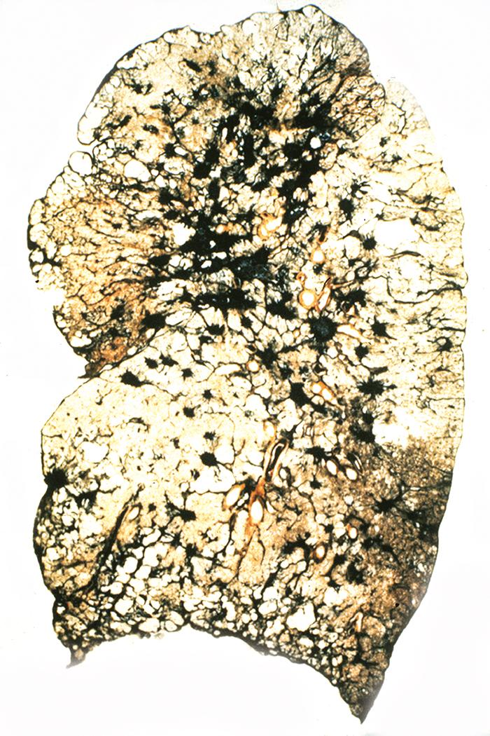 Figure 10.17, Simple coal worker’s pneumoconiosis. This thin section of lung demonstrates multiple small circumscribed black nodules, predominantly in the upper lobe.